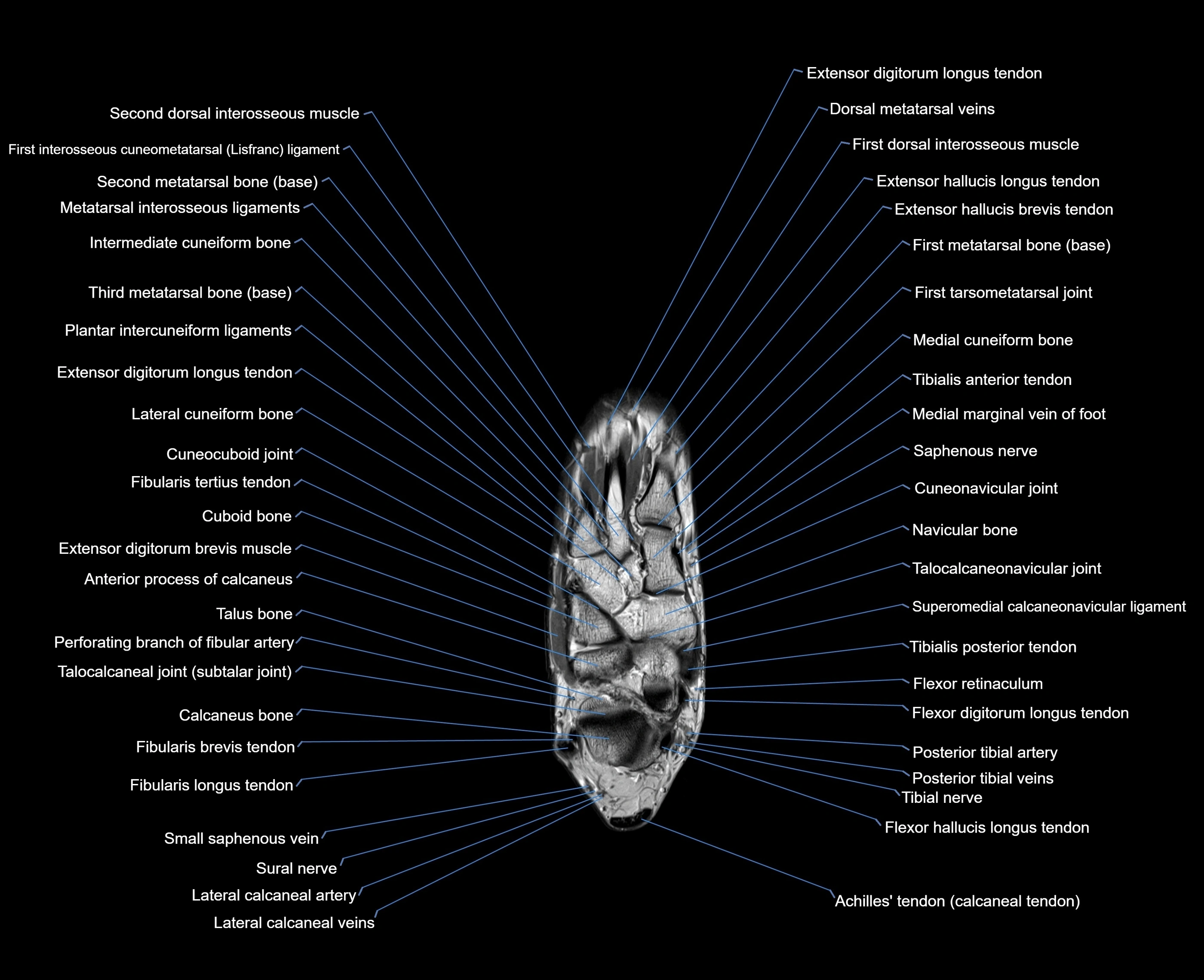 MRI foot coronal cross sectional anatomy 3T  radiology  image-img-00001-00016.webp